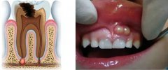 牙齦上反復長小膿包為什麼吃藥不能好呢？