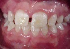牙齒的發育狀況可以反映孩子的健康情況嗎？