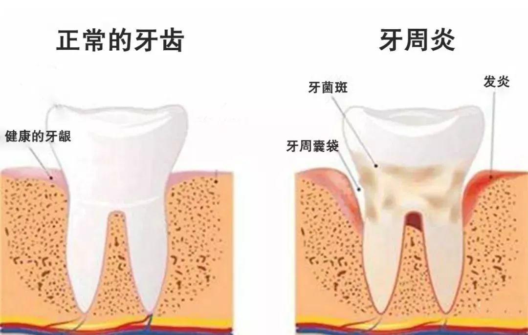 牙周炎治療