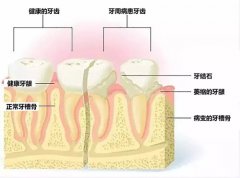 牙周疾病到底是一種什麼病呢？