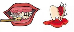 牙龈出血是怎么回事？怎样治疗？