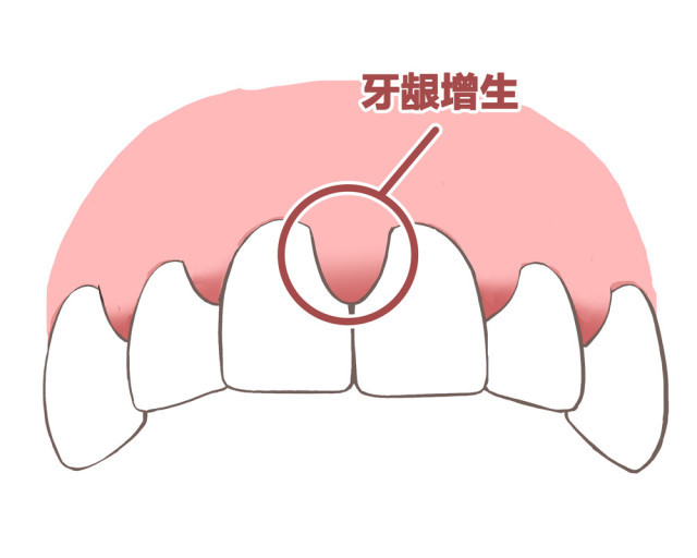 深圳牙齦治療