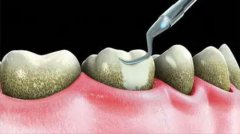 牙石和牙垢有什麼區別呢？