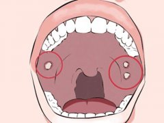 什麼是口腔黏膜病？