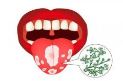 口腔內也能發生結核病嗎？