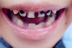 兒童為何易患齲齒？
