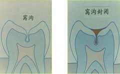 什麼是窩溝封閉法？有什麼作用？