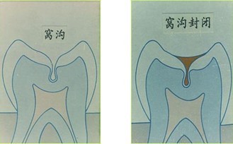 深圳窩溝封閉