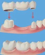 牙齒拔除後需多長時間方可鑲牙？可以不鑲牙嗎？