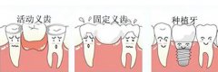 假牙有幾種類型呢？