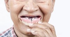 戴假牙會引起口腔炎症嗎？