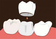 鑲牙後需要定期到牙科檢查嗎？