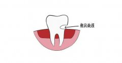 牙根部有條溝是怎麼形成的？如何治療？