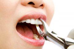 拔牙術後應注意哪些事情？
